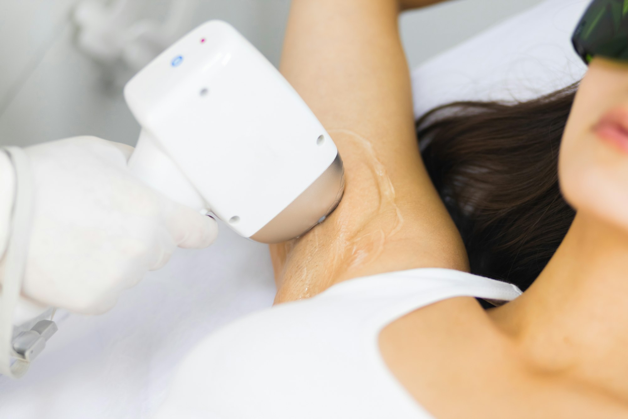 Close-up of armpit hair removal with laser